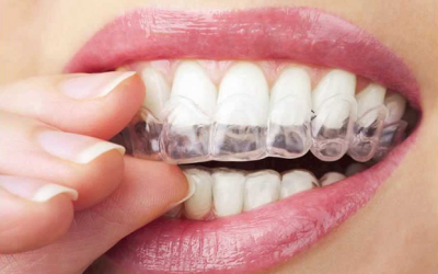 Invisalign Doctor